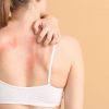 As alergias que atingem a pele são comuns no verão