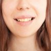 Manchas nos dentes: confira formas de prevenção e tratamento