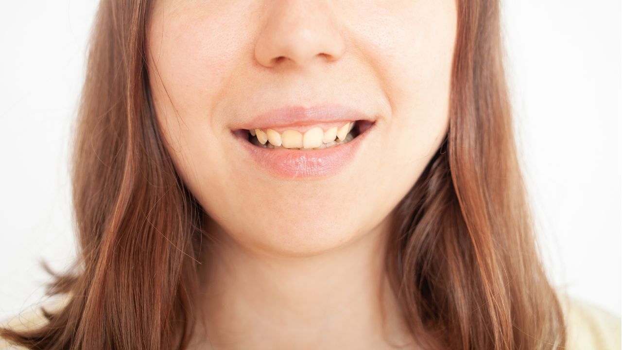 Manchas nos dentes: confira formas de prevenção e tratamento
