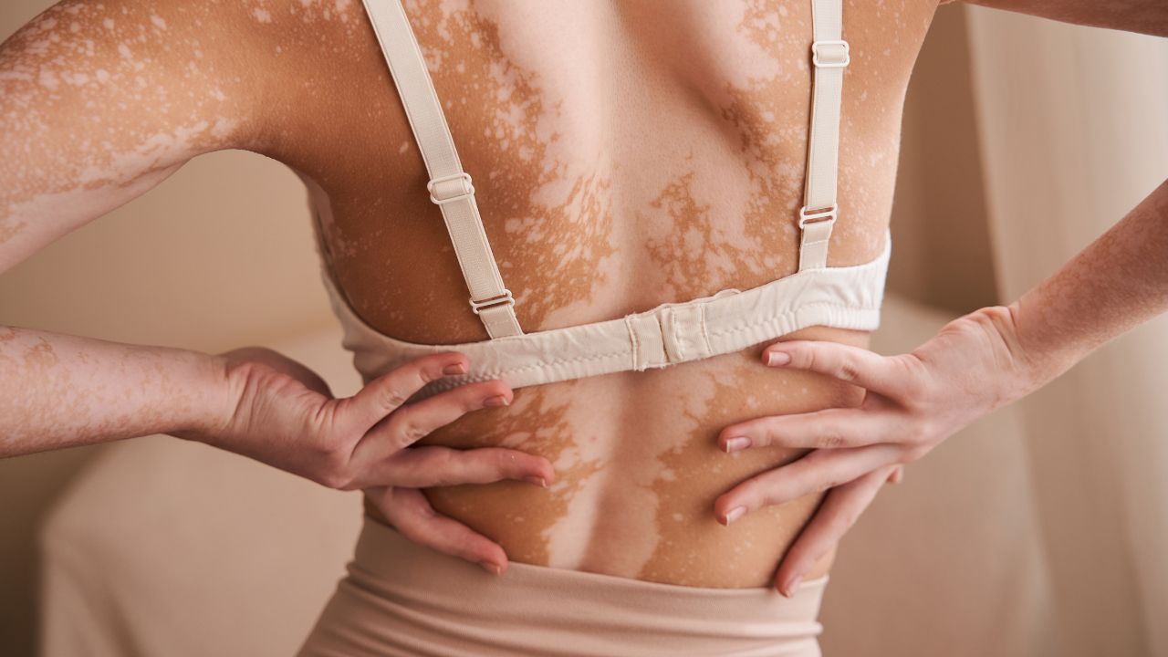 Vitiligo: conheça os sintomas, tratamento e impacto da doença