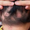 Alopecia areata: conheça a causa e tratamento da condição