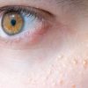 O milium se manifesta como lesões pequenas localizadas frequentemente na área dos olhos, bochechas, nariz e outras partes do corpo