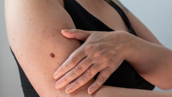Tratamentos estéticos para tratar manchas e pintas escuras podem acelerar quadro de câncer de pele