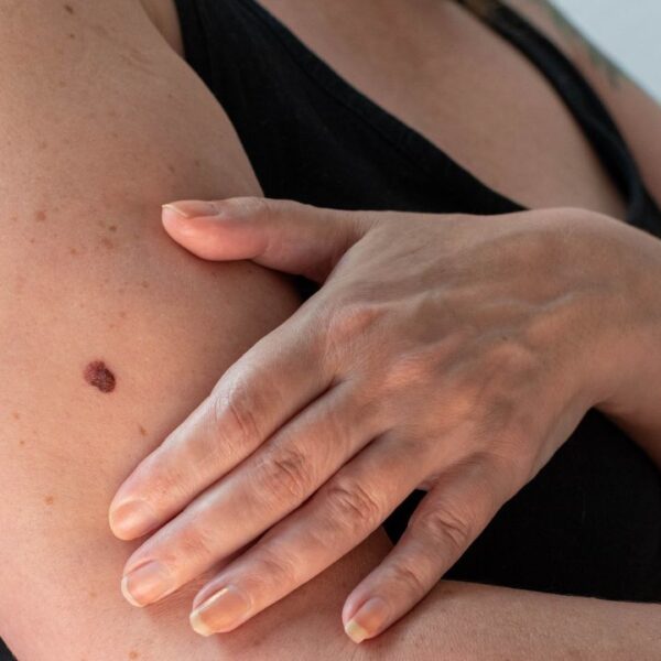 Tratamentos estéticos para tratar manchas e pintas escuras podem acelerar quadro de câncer de pele