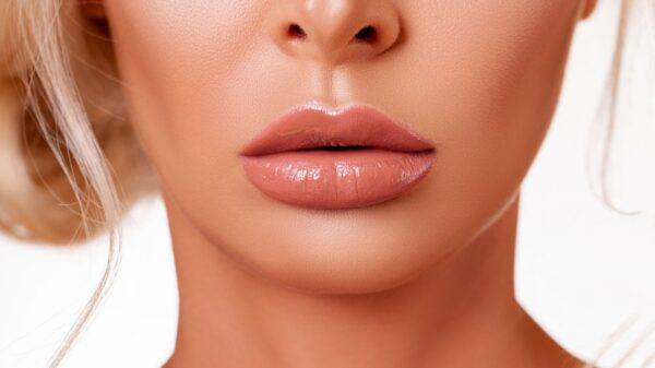 Dermatologista esclarece as principais dúvidas sobre o procedimento estético para melhorar a aparência dos lábios