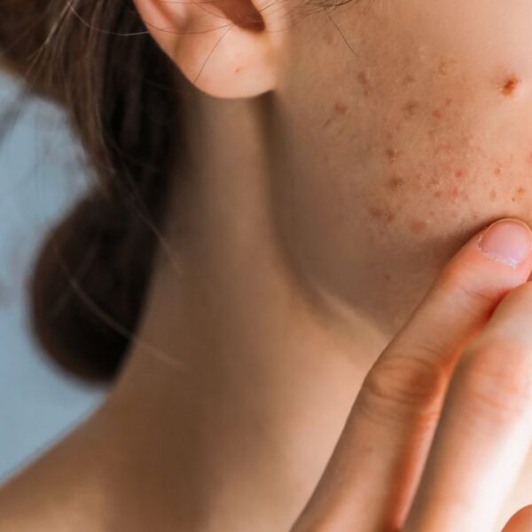 Saiba como não errar no tratamento para acne