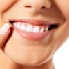 Especialista esclarece as principais dúvidas sobre o clareamento dental e alerta para os cuidados com receitas caseiras