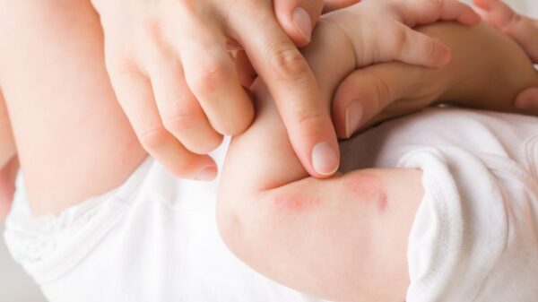 A pele do bebê é bastante delicada durante os primeiros meses de vida, exigindo cuidado e atenção redobrados
